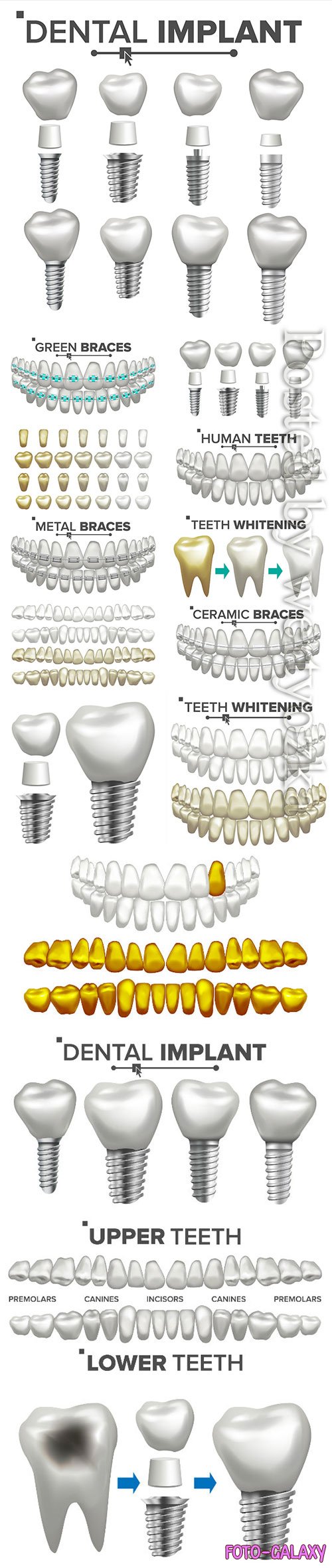 Dental implant illustration vector set